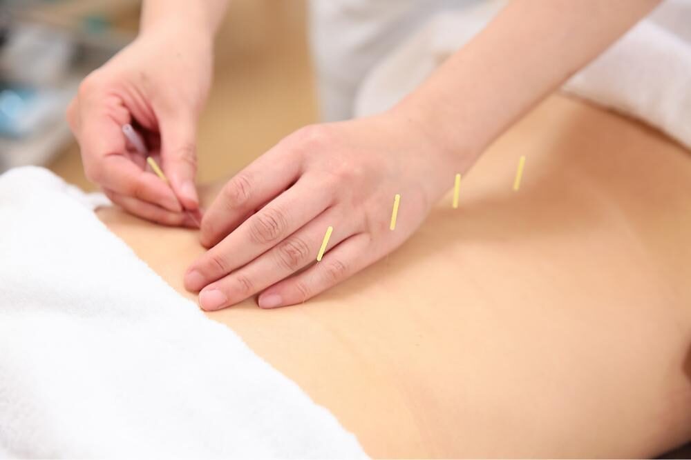 鍼灸治療でダイエット！体質を改善して痩せやすい身体を手に入れよう